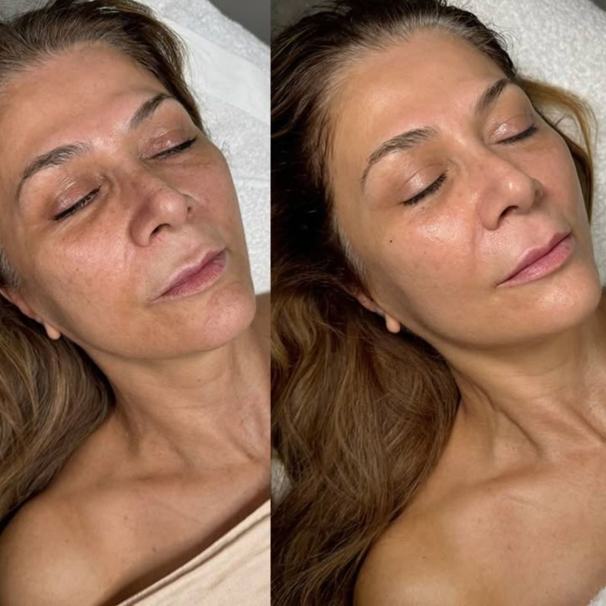Before and after photo of a patient treated at VTIARA Clinic, Bangalore