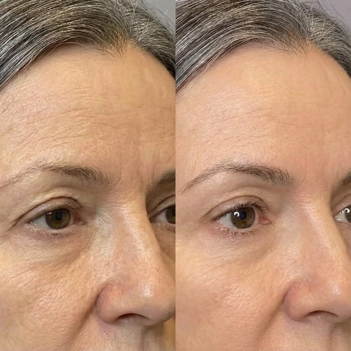 Before and after photo of a patient treated at VTIARA Clinic, Bangalore