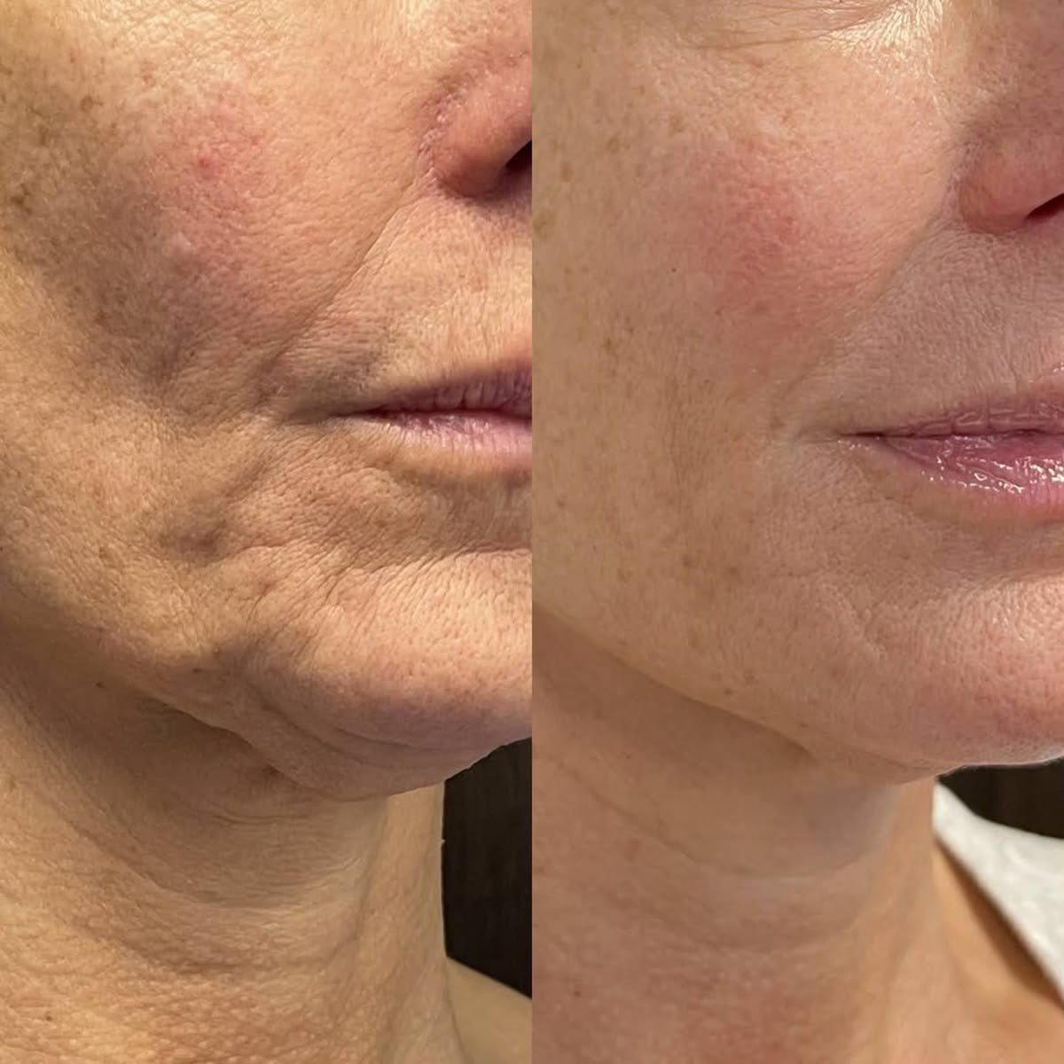 Before and after photo of a patient treated at VTIARA Clinic, Bangalore